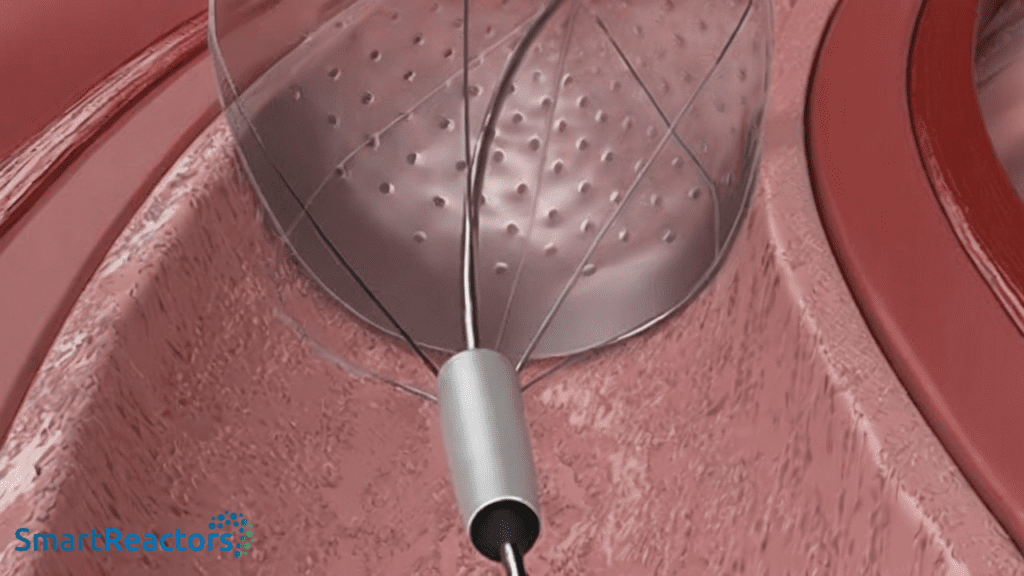 A detailed 3D medical illustration depicting a catheter with a balloon-like structure inserted into a blood vessel. The balloon is transparent with a dotted texture, suggesting a medical procedure such as angioplasty. The catheter is metallic and cylindrical, extending into the vessel, which is shown in shades of pink and red, representing the inner walls of the artery. The layout focuses on the interaction between the catheter and the vessel, highlighting the medical device's function. The image is devoid of any text or logos, maintaining a clinical and educational style.