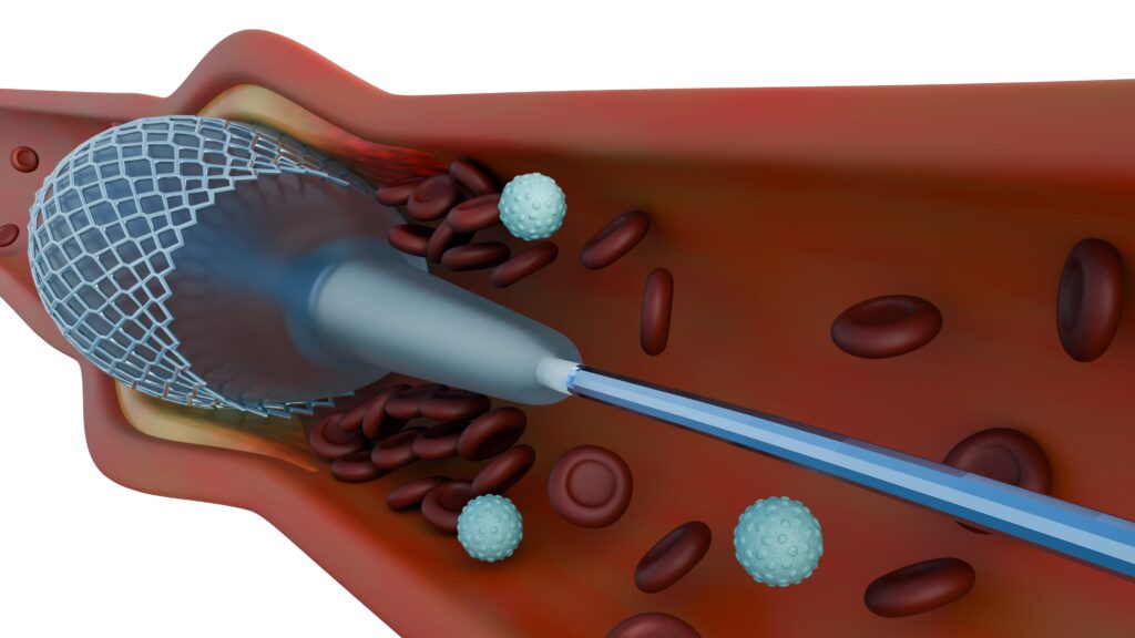 Advancing Septal Occluders: The Critical Role of Camouflage™ Coating in Cardiac Care