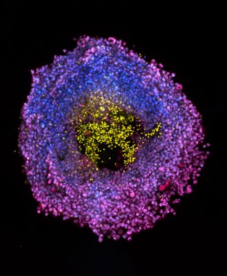 Oncology-cancer-spheroid-retourch