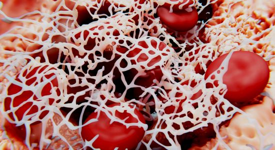 Erythrocytes (red blood cells) are trapped within a fibrin mesh.