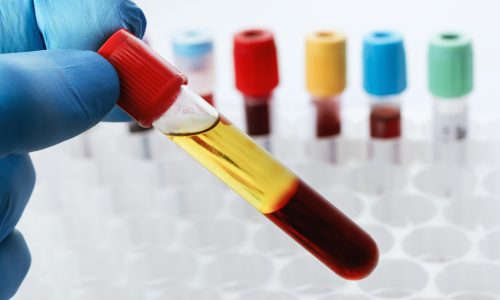 Blood drawn from a patient with Serum separate in the chemistry laboratory. Lab technician holding a test tube of blood sample after being centrifuged